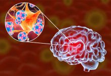 بیماری زمان تزریق واکسن مننژیت+ مراقبت بعد از واکسن مننژیت