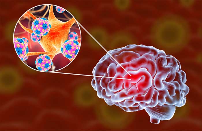 بیماری زمان تزریق واکسن مننژیت+ مراقبت بعد از واکسن مننژیت