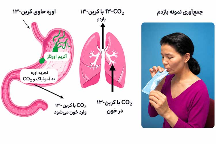 تست تنفسی اوره