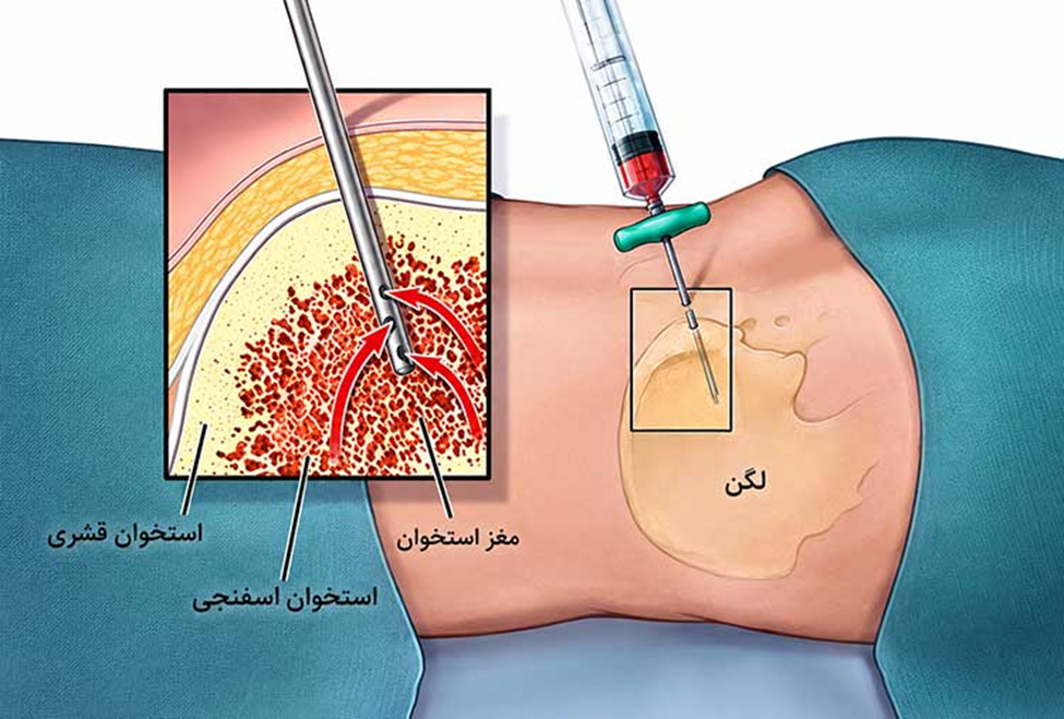 نمونه‌برداری مغز استخوان